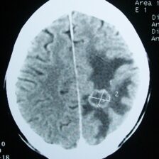 Žiarenie z mobilných telefónov spôsobuje nádory na mozgu a malo by byť klasifikované ako pravdepodobný ľudský karcinogén (2A)