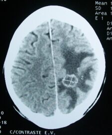 CT_brain_tumor>